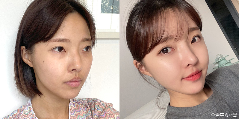성형 전후 셀카 사진 - 지앤지병원