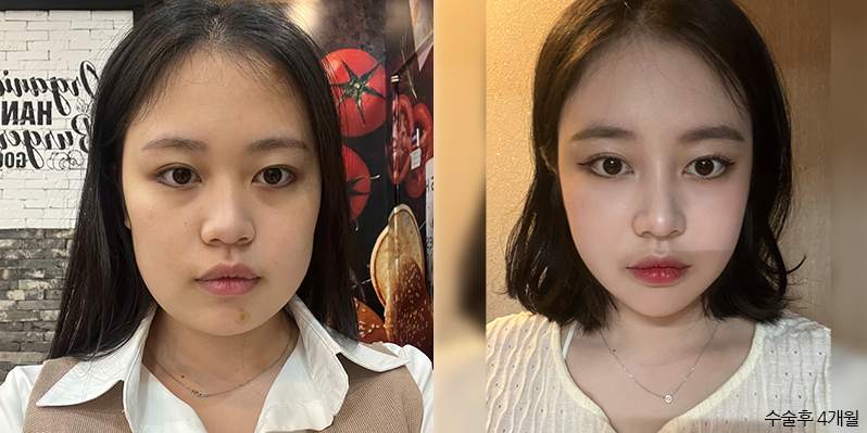 성형 전후 셀카 사진 - 지앤지병원