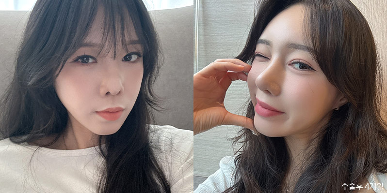 성형 전후 셀카 사진 - 지앤지병원
