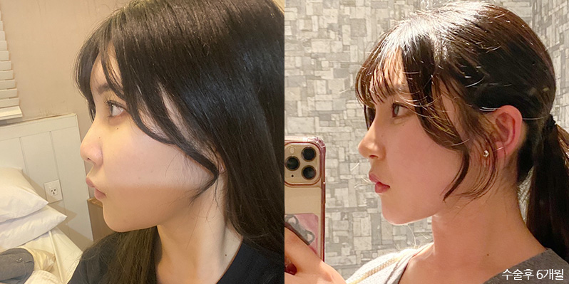 성형 전후 셀카 사진 - 지앤지병원