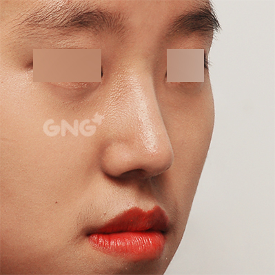 성형 전후사진