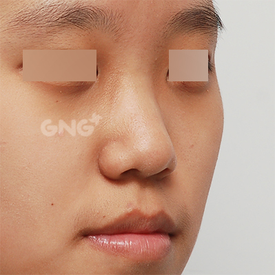 성형 전후사진