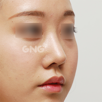 성형 전후사진
