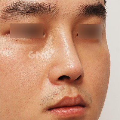 성형 전후사진
