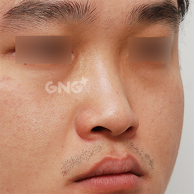 성형 전후사진