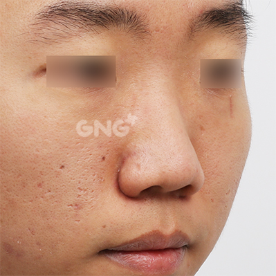 성형 전후사진