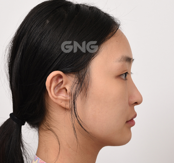성형 전후사진