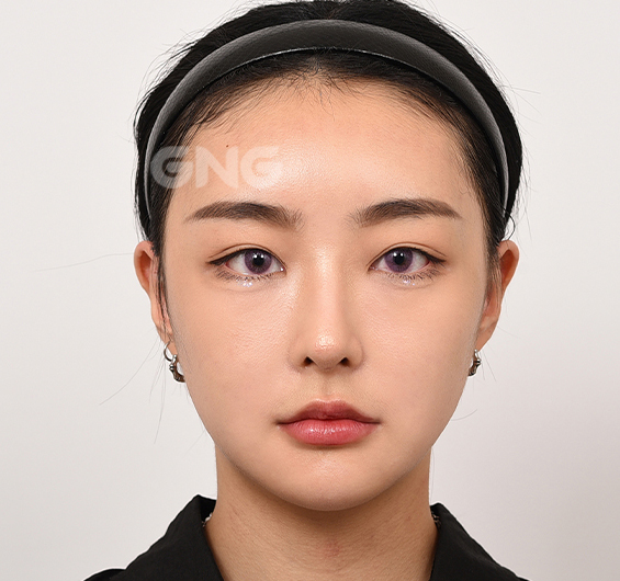 성형 전후사진