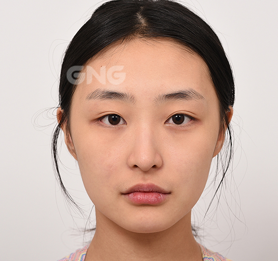 성형 전후사진
