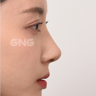 성형 전후사진