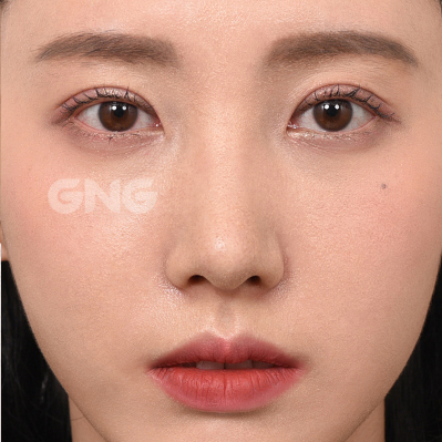 성형 전후사진