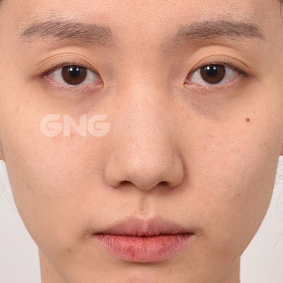 성형 전후사진