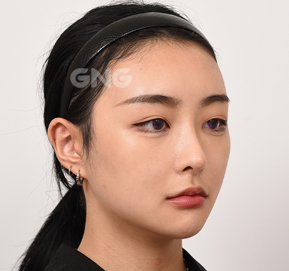 성형 전후사진