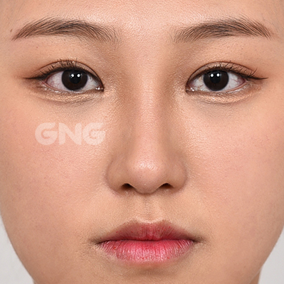 성형 전후사진