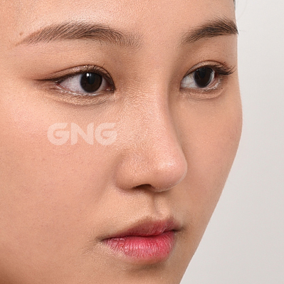 성형 전후사진