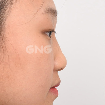 성형 전후사진