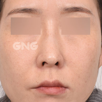 성형 전후사진