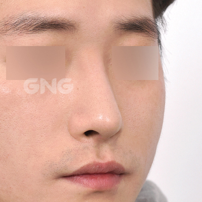 성형 전후사진