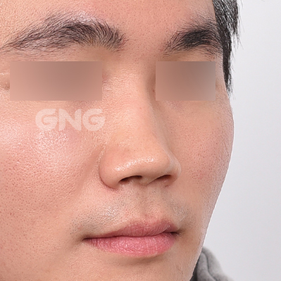 성형 전후사진
