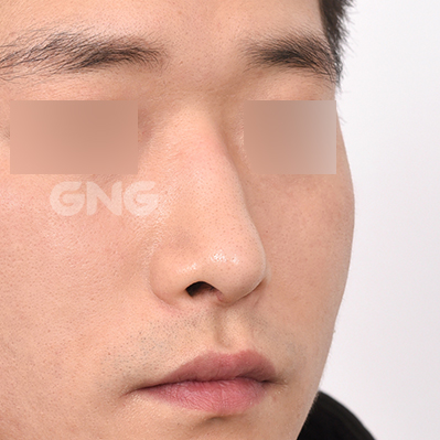 성형 전후사진