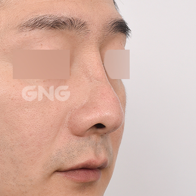 성형 전후사진