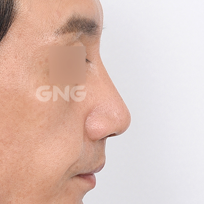 성형 전후사진
