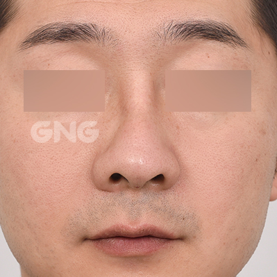 성형 전후사진