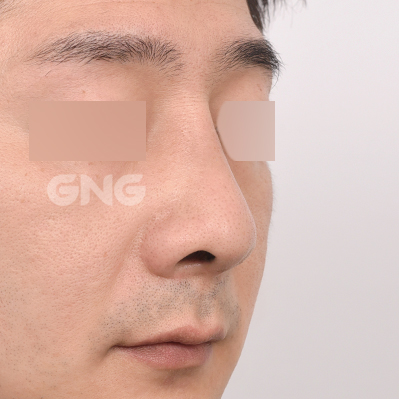 성형 전후사진