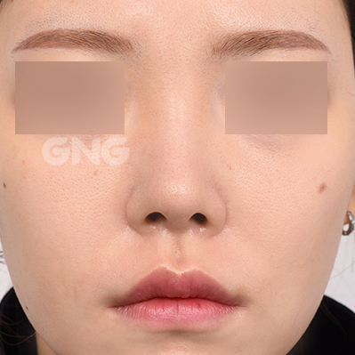 성형 전후사진