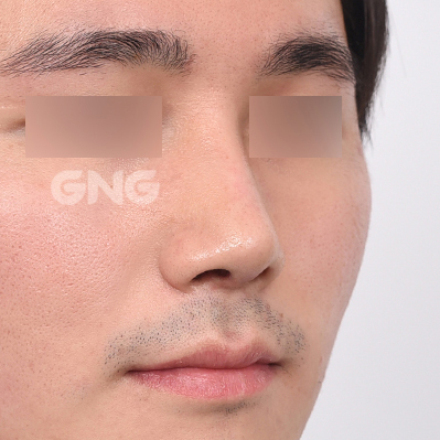 성형 전후사진