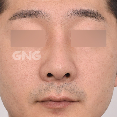 성형 전후사진