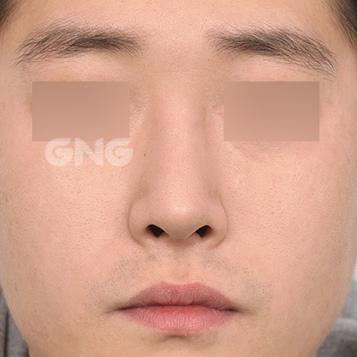 성형 전후사진