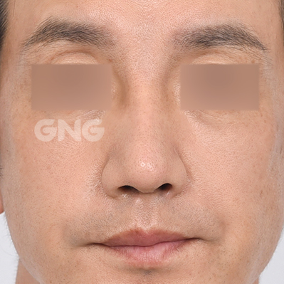 성형 전후사진