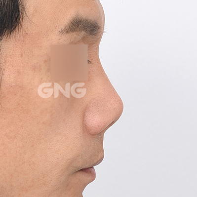 성형 전후사진