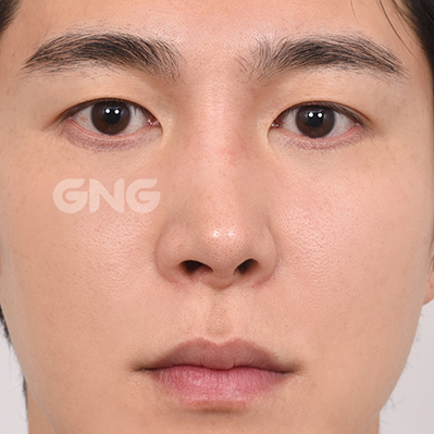 성형 전후사진