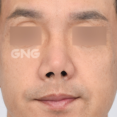 성형 전후사진