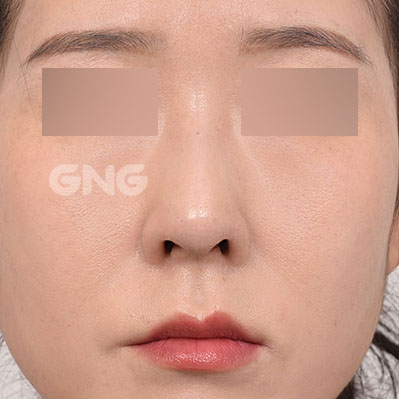 성형 전후사진