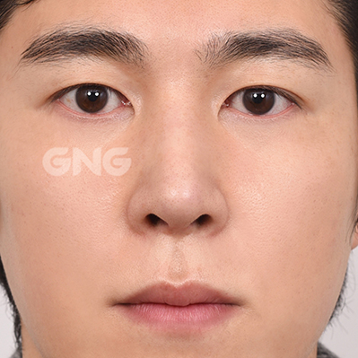 성형 전후사진