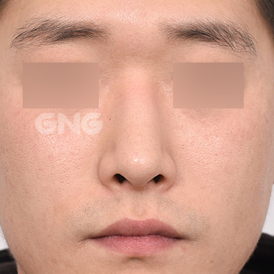 성형 전후사진