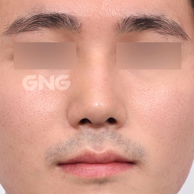 성형 전후사진