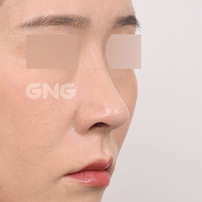 성형 전후사진