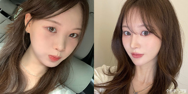 성형 전후 셀카 사진 - 지앤지병원