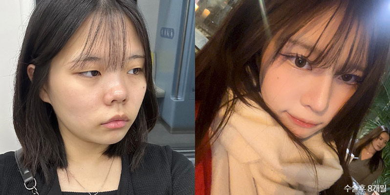 성형 전후 셀카 사진 - 지앤지병원