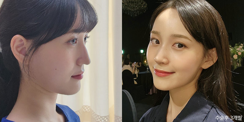 성형 전후 셀카 사진 - 지앤지병원