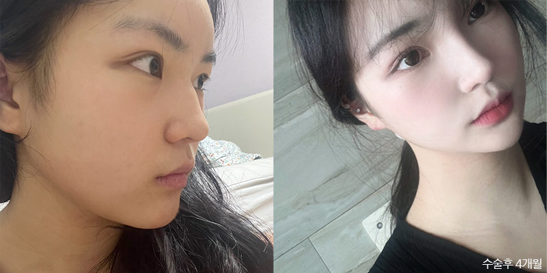성형 전후 셀카 사진 - 지앤지병원