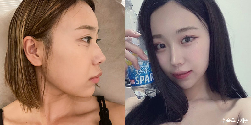 성형 전후 셀카 사진 - 지앤지병원