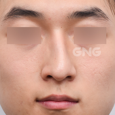 성형 전후사진