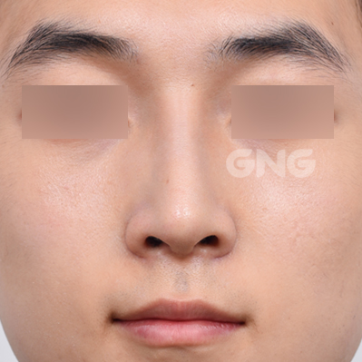 성형 전후사진