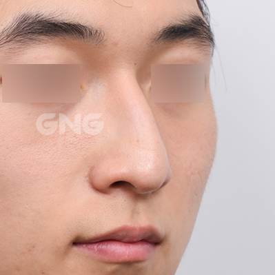 성형 전후사진
