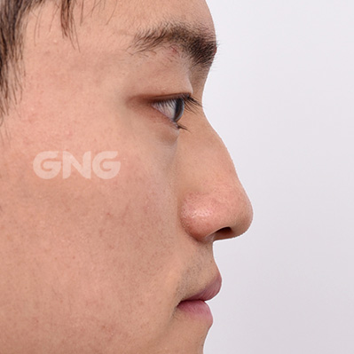 성형 전후사진
